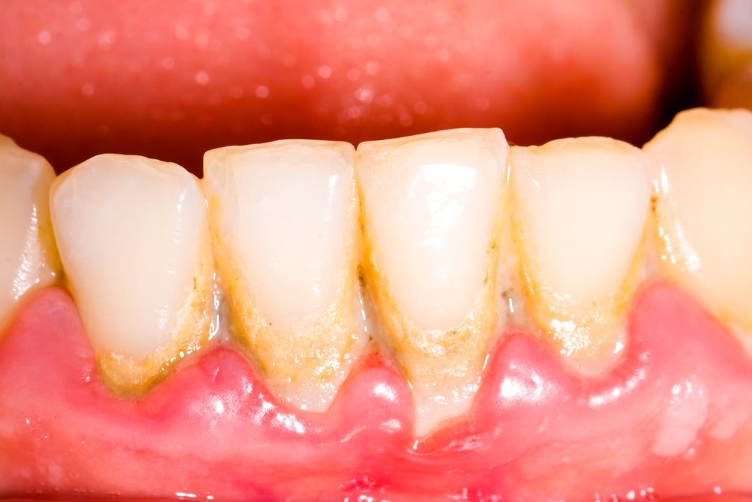 Close up of teeth with yellow plaque