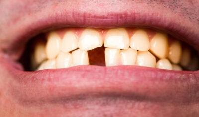 Close up of a mouth with a missing lower tooth