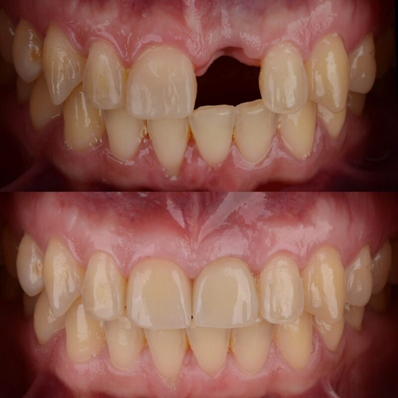 Mouth before and after replacing a missing upper tooth