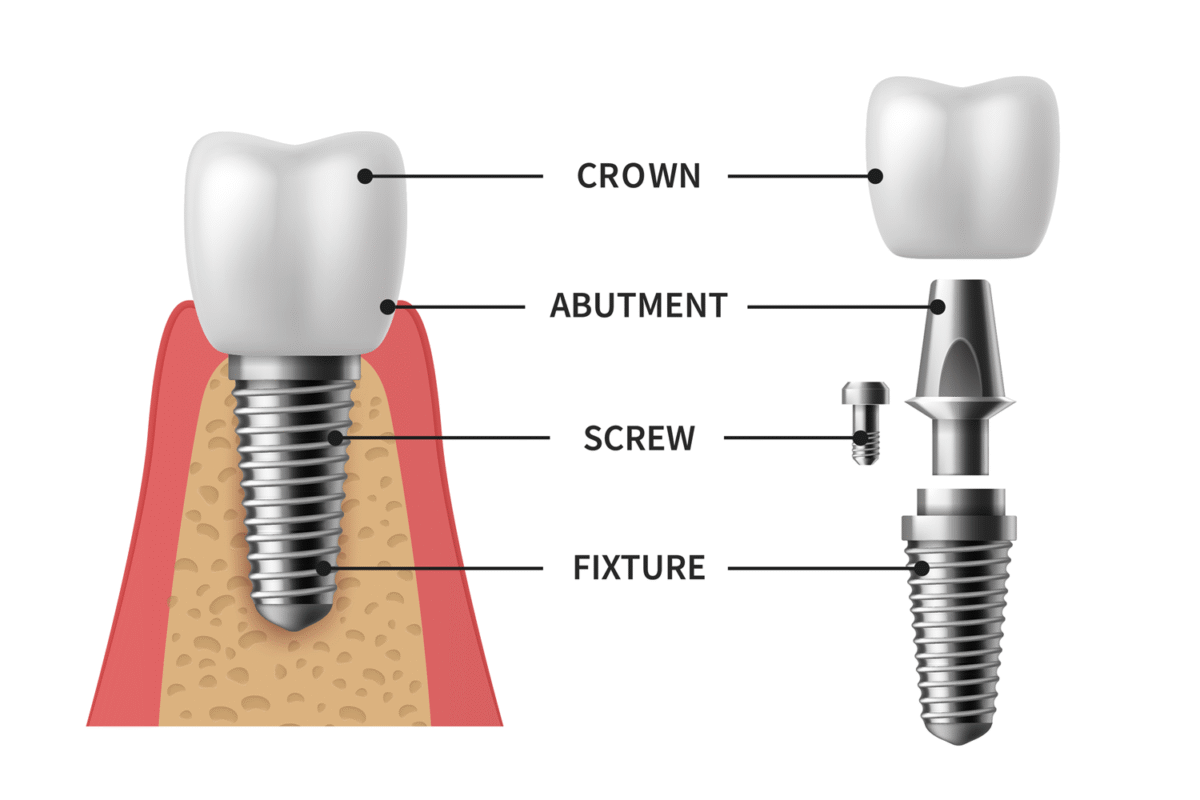 Diagram of the parts of a dental implant