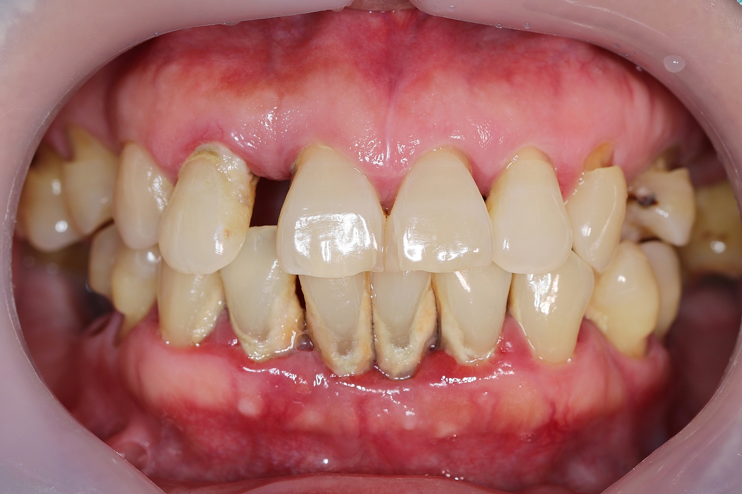 Mouth with damaged teeth and receding gums
