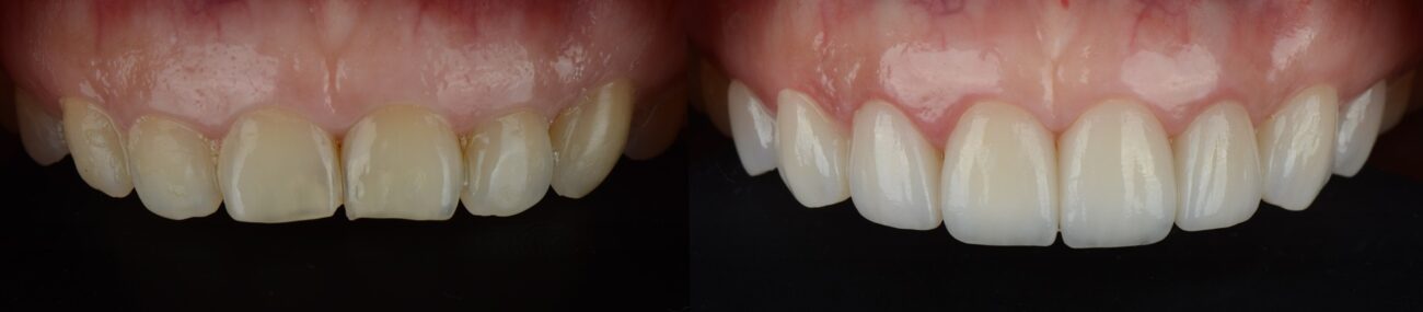 Teeth before and after whitening and restoring them