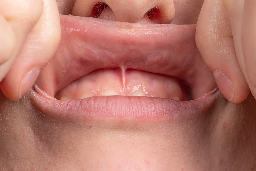 Person pulling back their upper lip