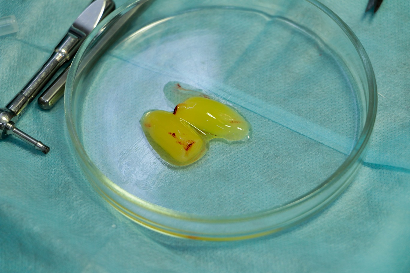 Platelet-rich fibrin in a petri dish