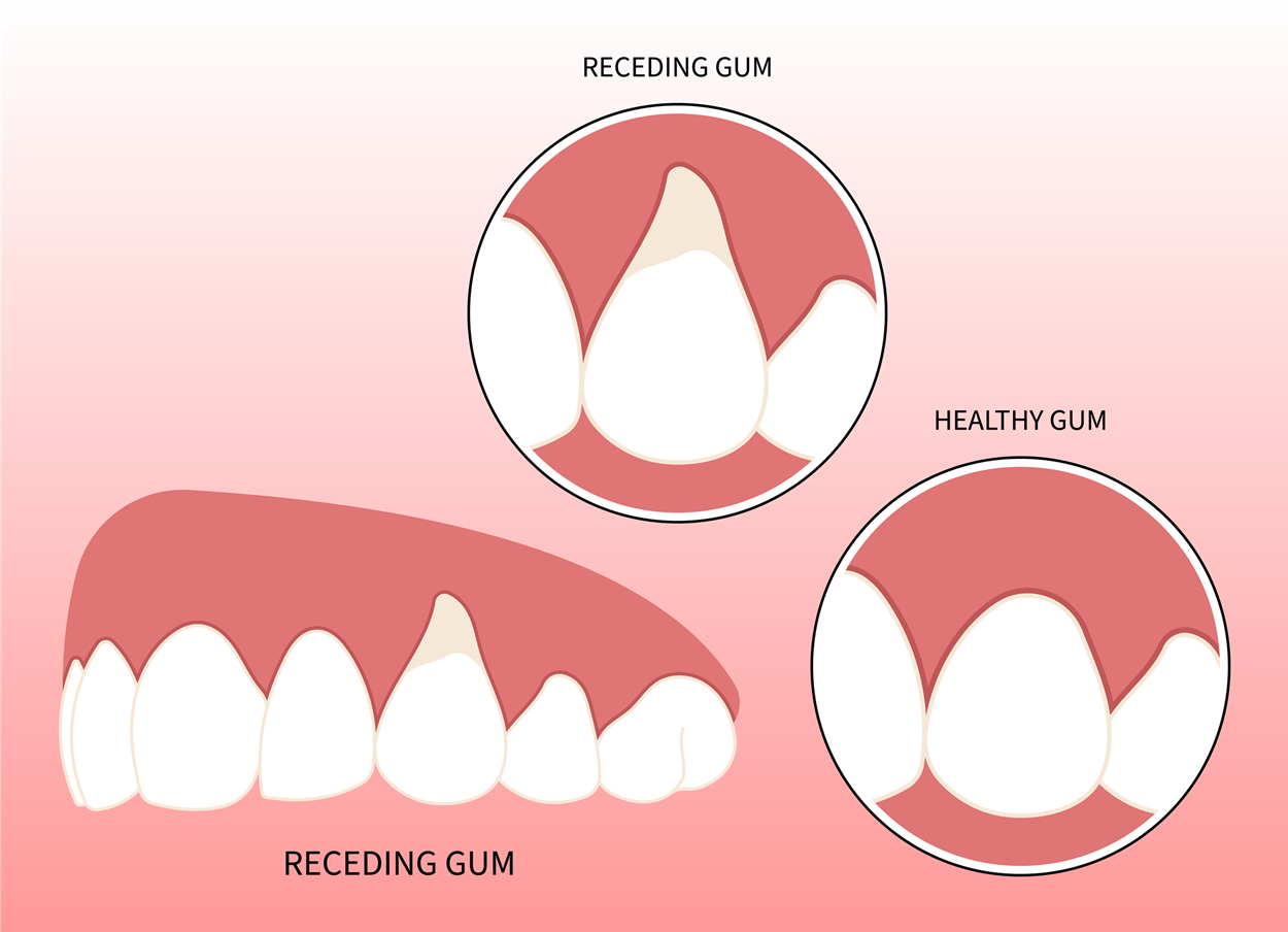 Illustration of healthy gums compared to receding gums