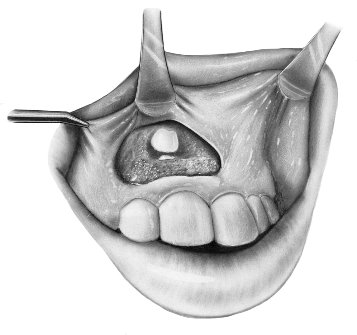Illustration of an impacted canine tooth being exposed