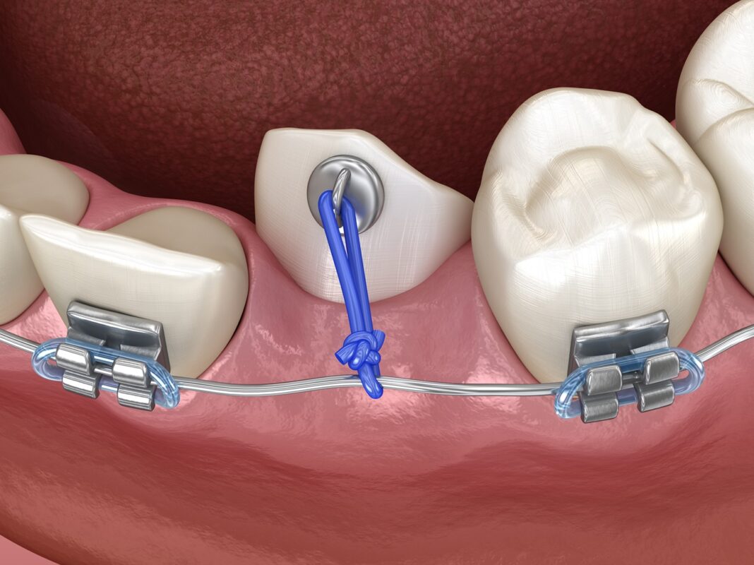 Illustration of an impacted tooth being corrected with braces and an elastic band