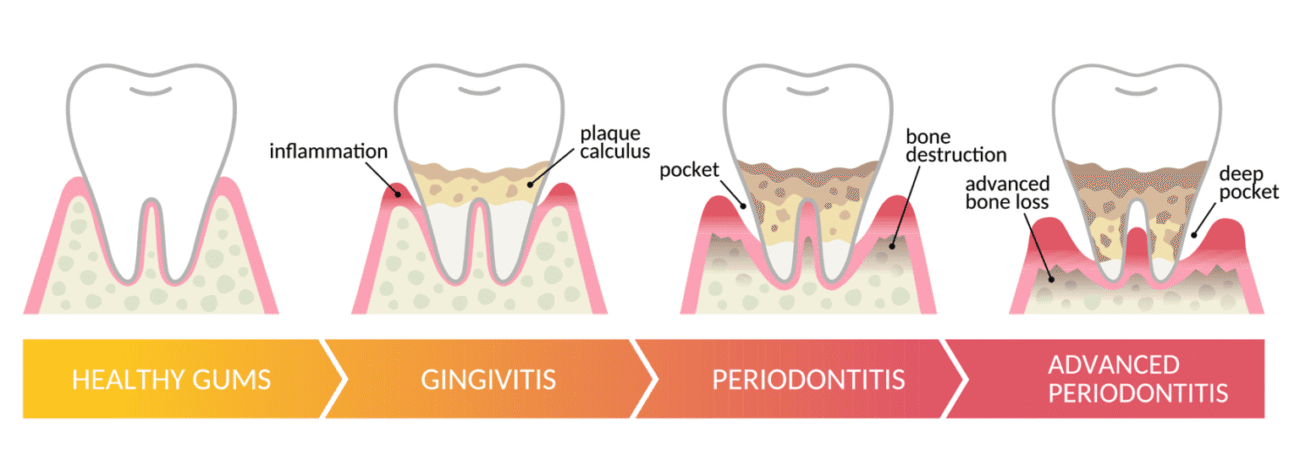 Illustration of the progression of gum disease