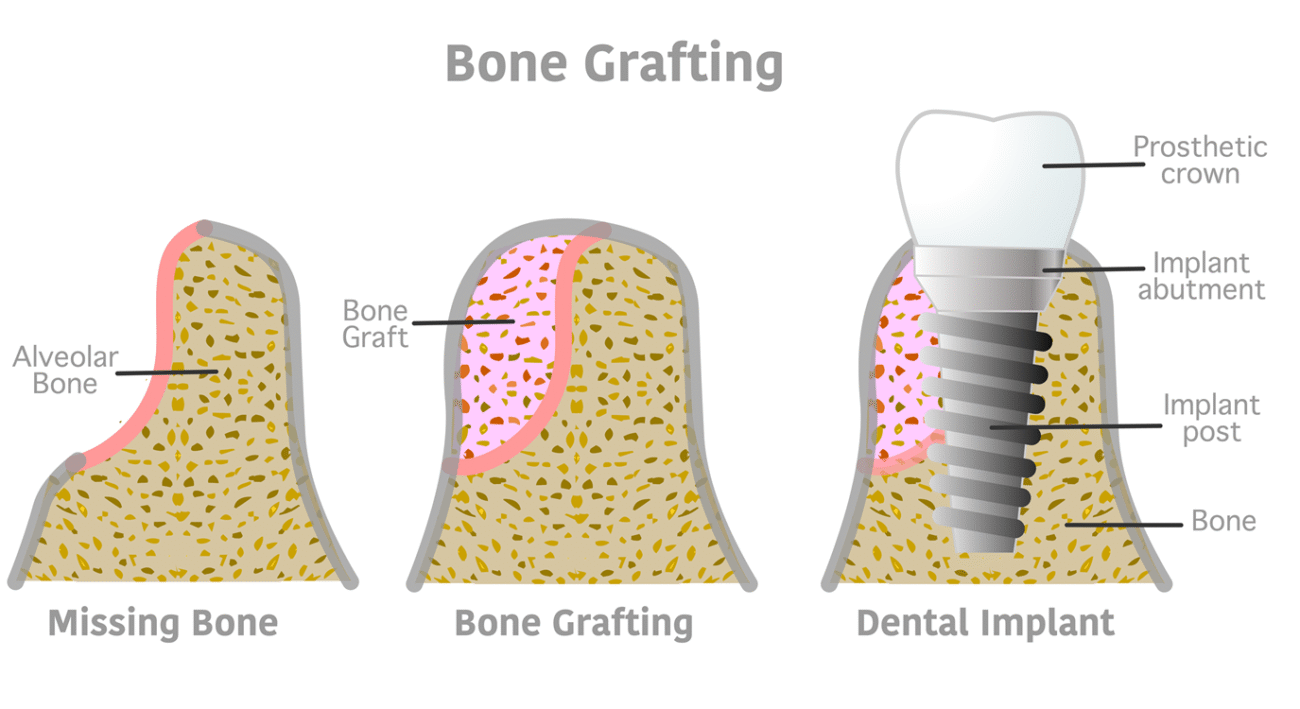 Illustration of the bone grafting process