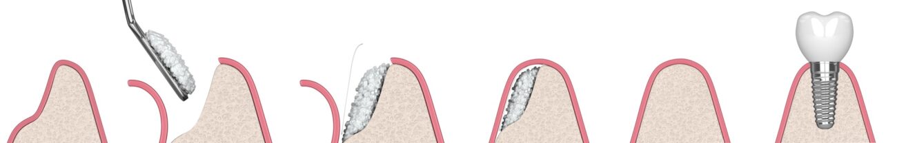 Illustrated bone grafting process