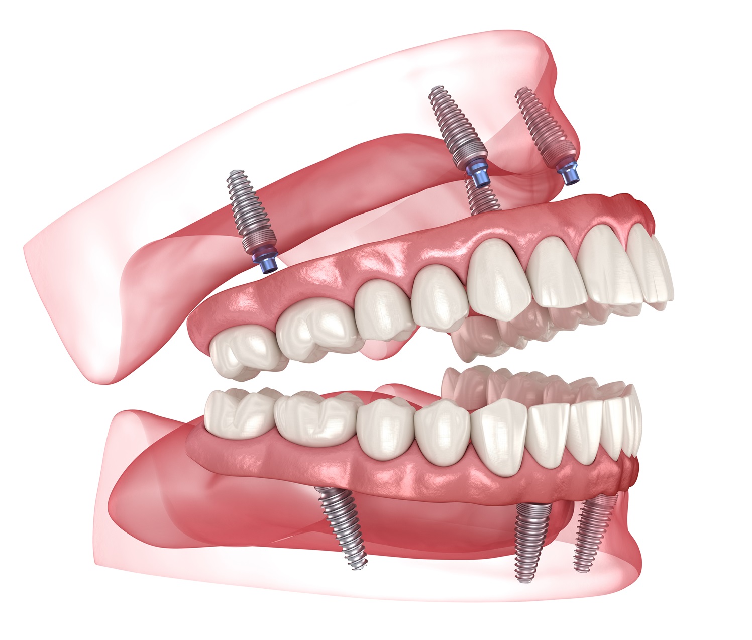 Illustration of All-on-4
