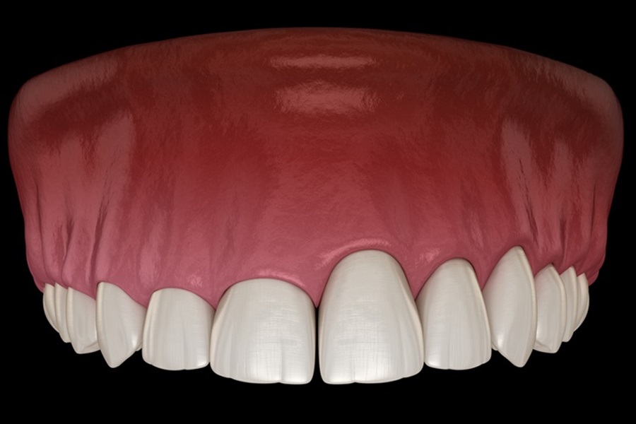 Illustration of an uneven gumline