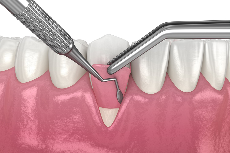 Illustration of a gum tissue graft