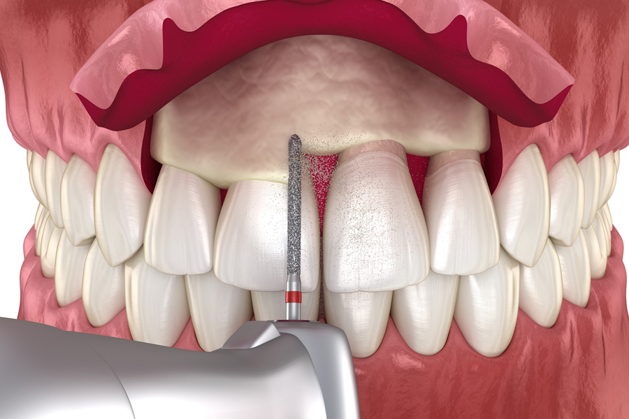 Illustration of crown lengthening