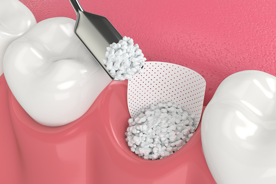 Illustration of a bone graft
