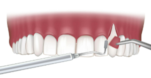 Illustration of gum grafting performed in upper arch
