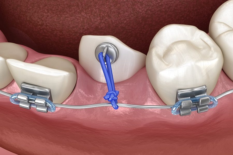 Illustration of an impacted tooth being corrected with braces and an elastic band