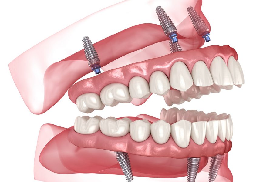 Illustration of All-on-4